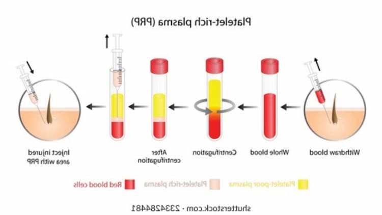 PRP